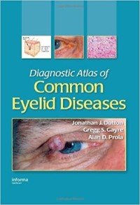 Image of Diagnostic Atlas of Common Eyelid Diseases